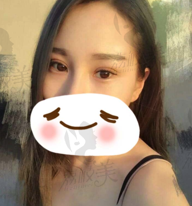 手术后.png?x-oss-process=style/lzmei