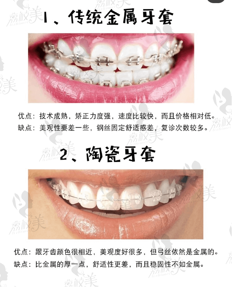 北京西尔口腔各种牙套