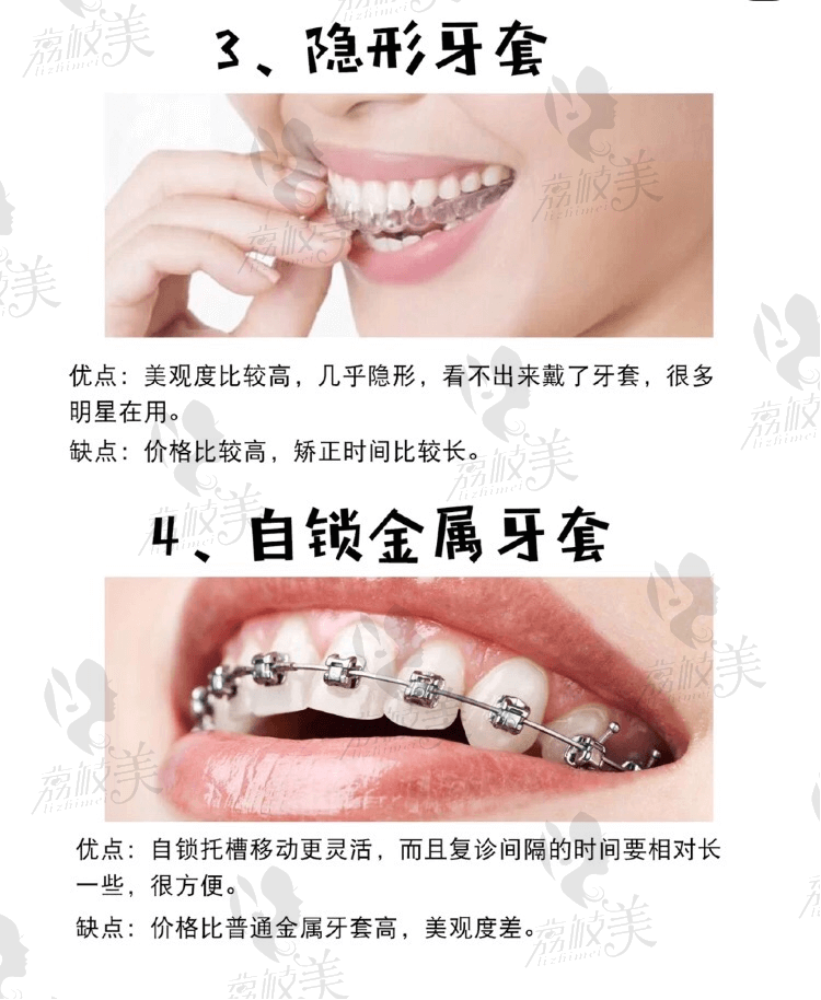 北京西尔口腔各种牙套对比