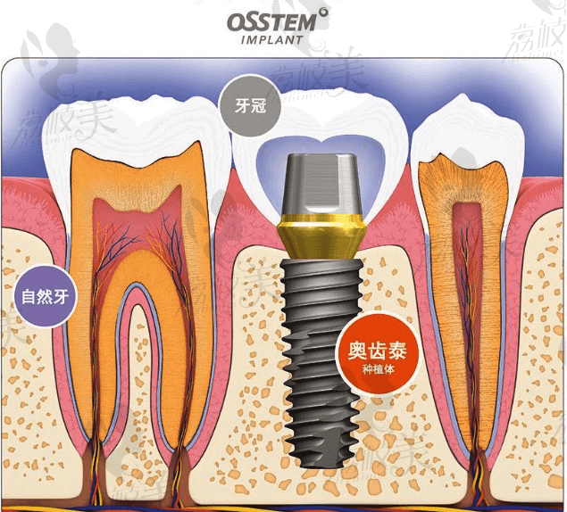 韩国奥齿泰种植体.png?x-oss-process=style/lzmei