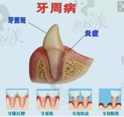 牙周病