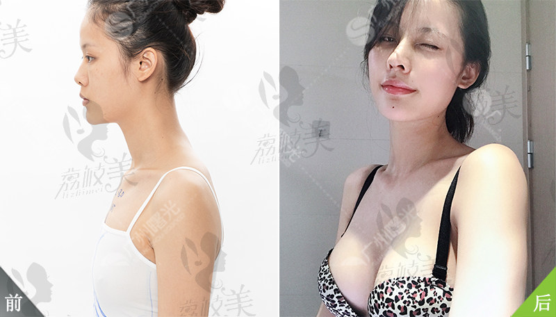 廣州曙光醫(yī)學美容醫(yī)院隆胸<span style= 廣州曙光醫(yī)學美容醫(yī)院隆胸<span style=