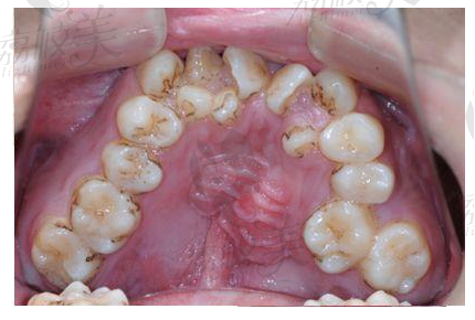 牙齿排列不齐会影响牙齿清洁