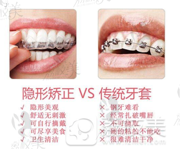 隐形矫正VS传统牙套.png?x-oss-process=style/lzmei
