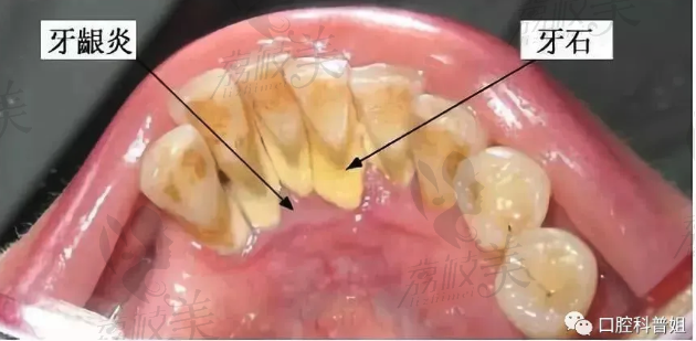 牙龈炎.png?x-oss-process=style/lzmei
