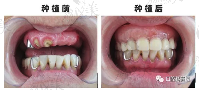 种植牙前后对比.png?x-oss-process=style/lzmei