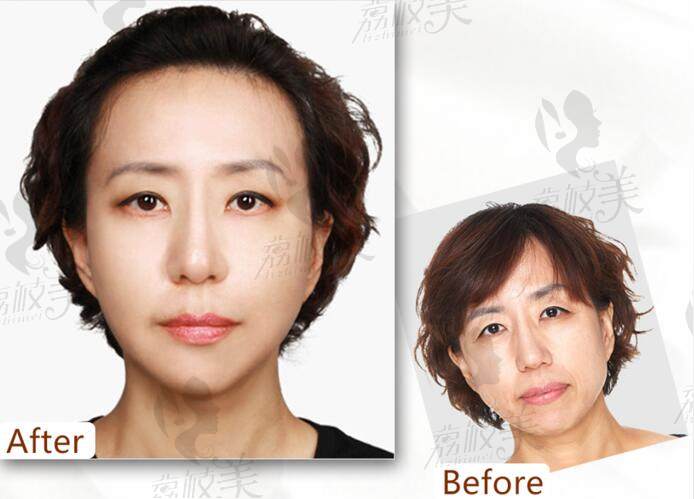 北京画美医院美容皮肤科主任抵抗老龄化老案例