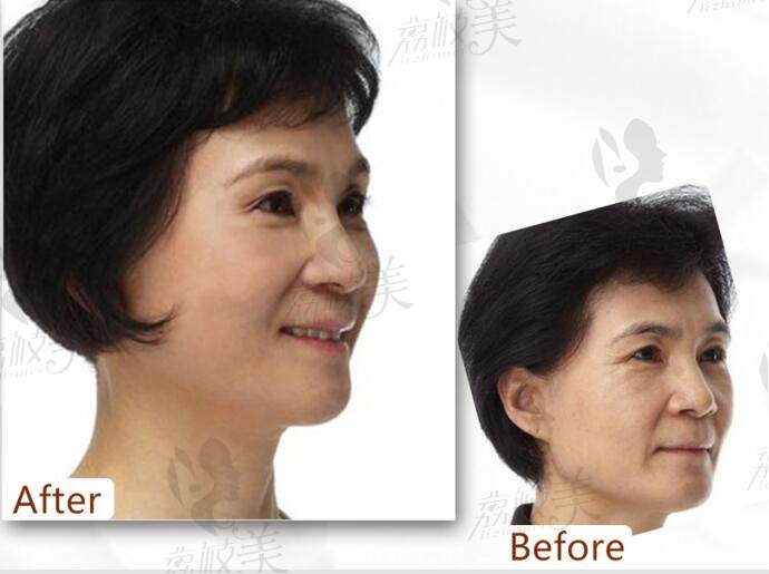 北京画美医院美容皮肤科主任抵抗老龄化老案例