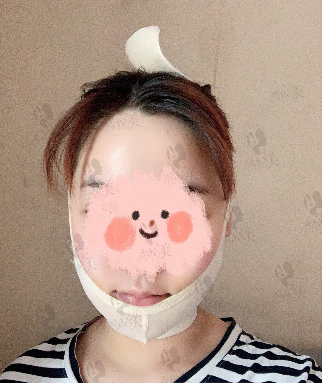 术后一周