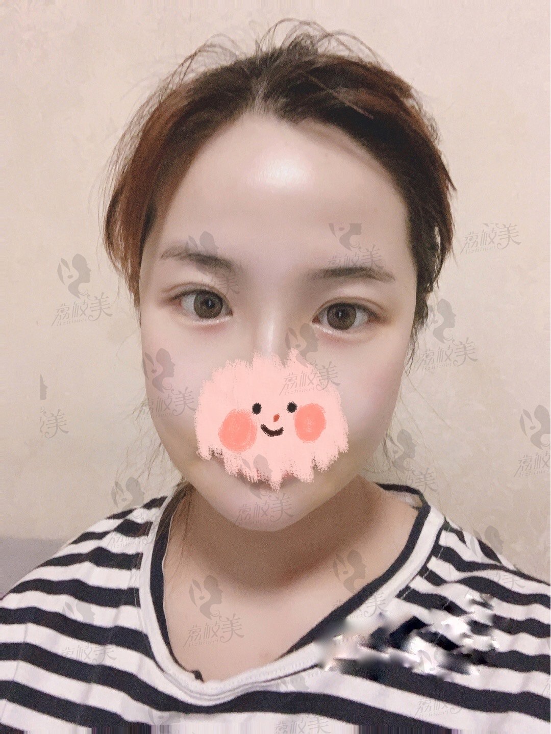 术后两周
