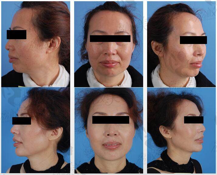 北京画美整形美容皮肤科斯日古楞主任皮肤综合治疗案例