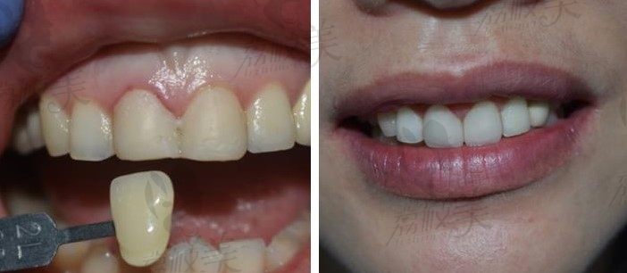 华蓥市何氏口腔诊所牙齿种植案例分享：