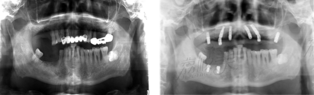 北京西尔口腔半口种植术前后医学影像对比
