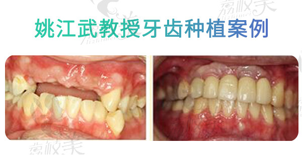 廈門麥芽口腔姚江武教授牙齒矯正案例分享