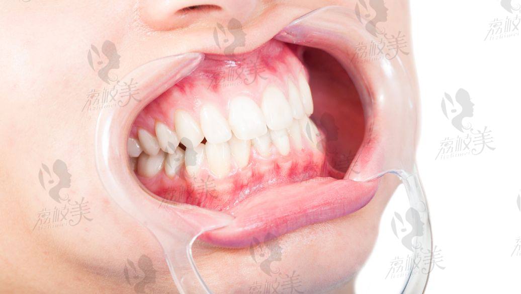 兰州韩美齿科开业钜惠大型优惠活动牙齿矫正只要6999元!