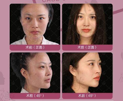 北京美莱做急速纳米美眼双眼皮案例