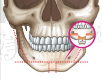 vline下颌角手术.png?x-oss-process=style/lzmei