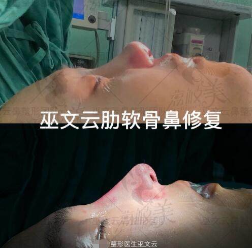 北京米扬丽格医疗美容门诊部巫文云院长肋软骨隆鼻修复案例