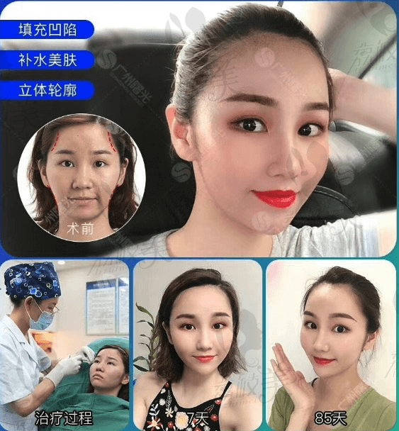 广州曙光玻尿酸全脸打造乔雅登玻尿酸9800/3支。