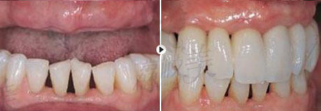 东莞莞城美立方医美口腔医院王济良主任牙齿种植案例分享