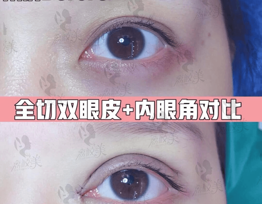 北京克莱美舍张冰洁眼综合案例