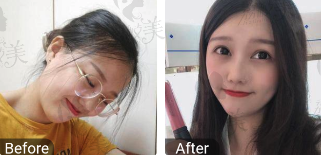 双眼皮<span style=
