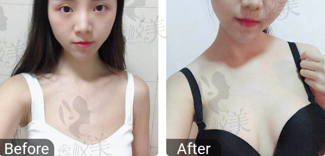 假体隆胸<span style=