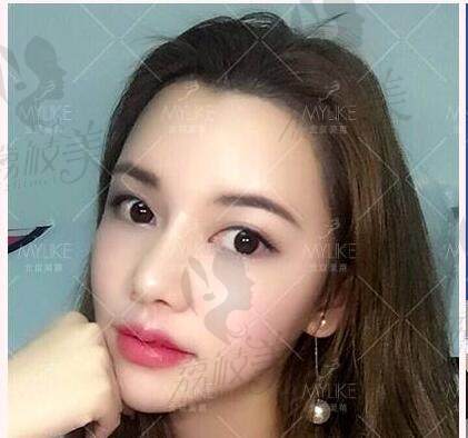 北京美萊董巖巖醫(yī)生綜合隆鼻術(shù)后半年效果