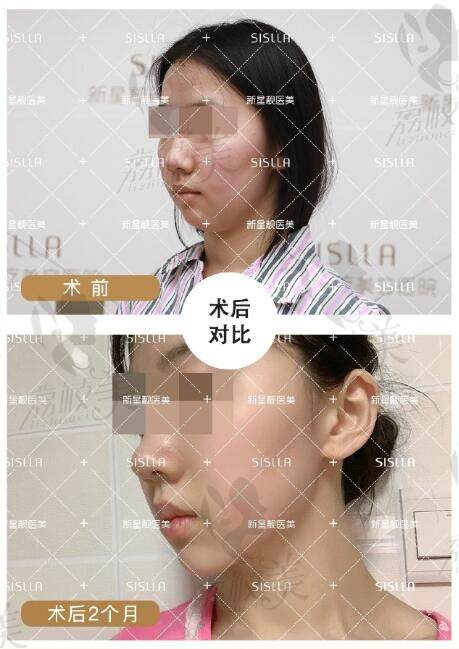 北京新星靓医学美容医院威塑双下巴吸脂案例：