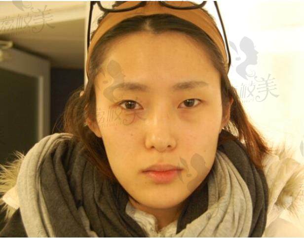 大众脸选择在韩国美佳整形做太值了,面部轮廓+隆鼻+双眼皮一套下来妥妥的明星脸