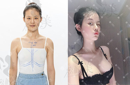 广州曙光整形医院刘杰伟主任3D悬提丰胸案例分享