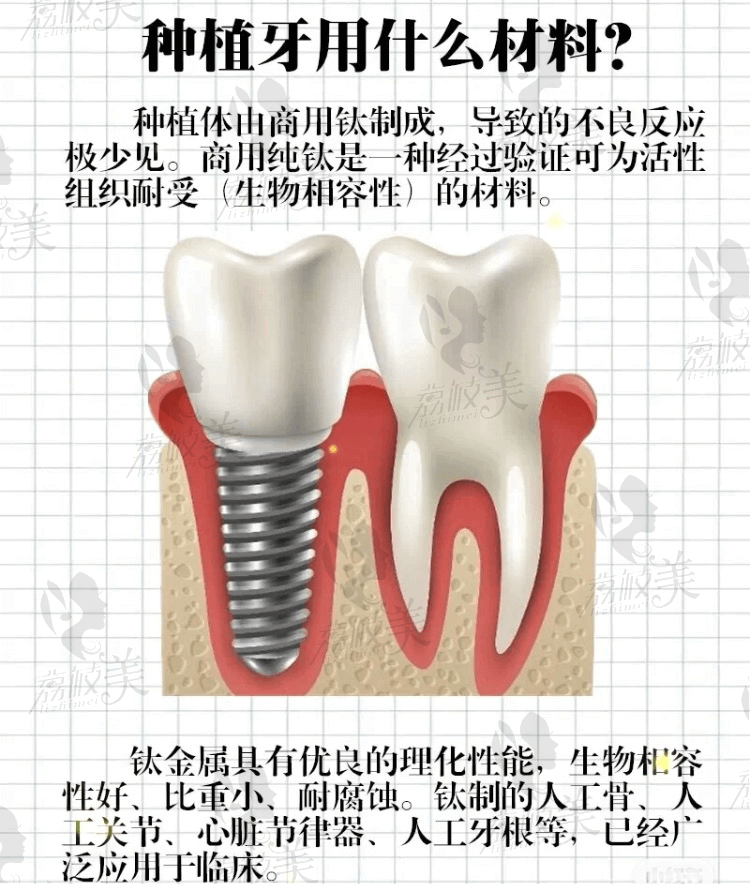 荔枝美：种植牙照片