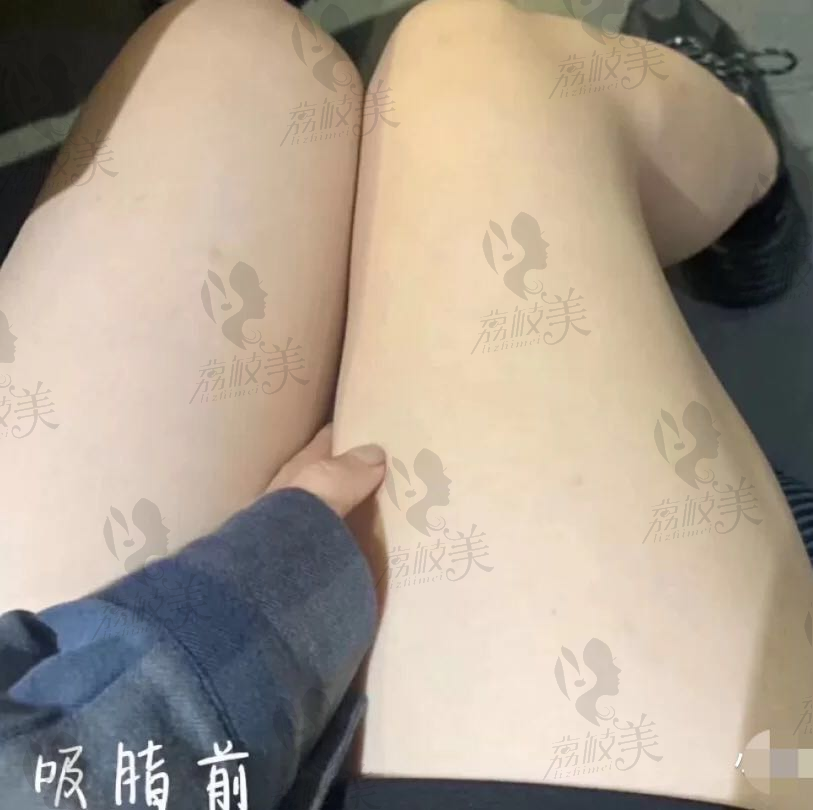 武汉亚韩整形外科医院大腿环吸手术案例