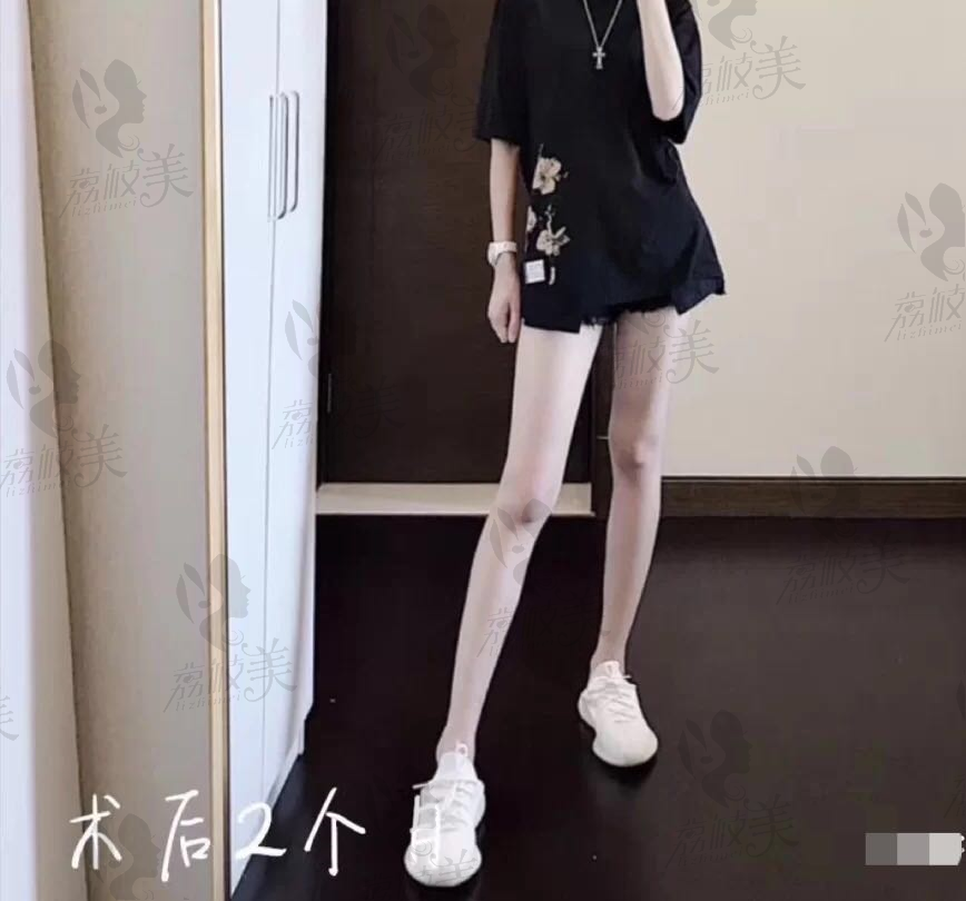武汉亚韩整形外科医院大腿环吸手术案例