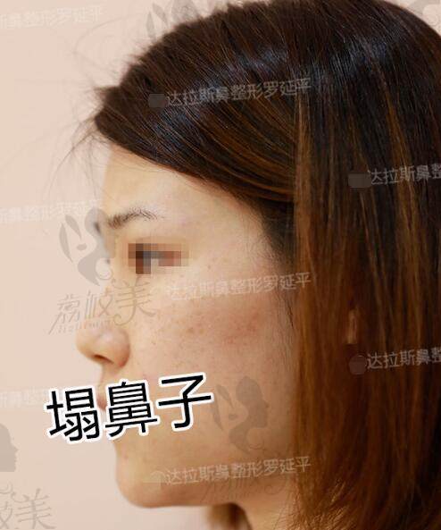 广州美莱罗延平院长做的肋软骨隆鼻案例术前