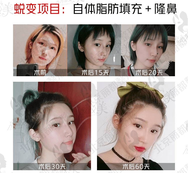 北京丽都医疗美容医院自体脂肪填充、隆鼻案例
