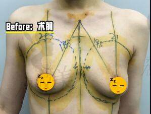 北京凯润婷医疗美容医院隆胸术前