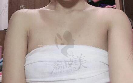CRT胶原蛋白丰胸术后一周
