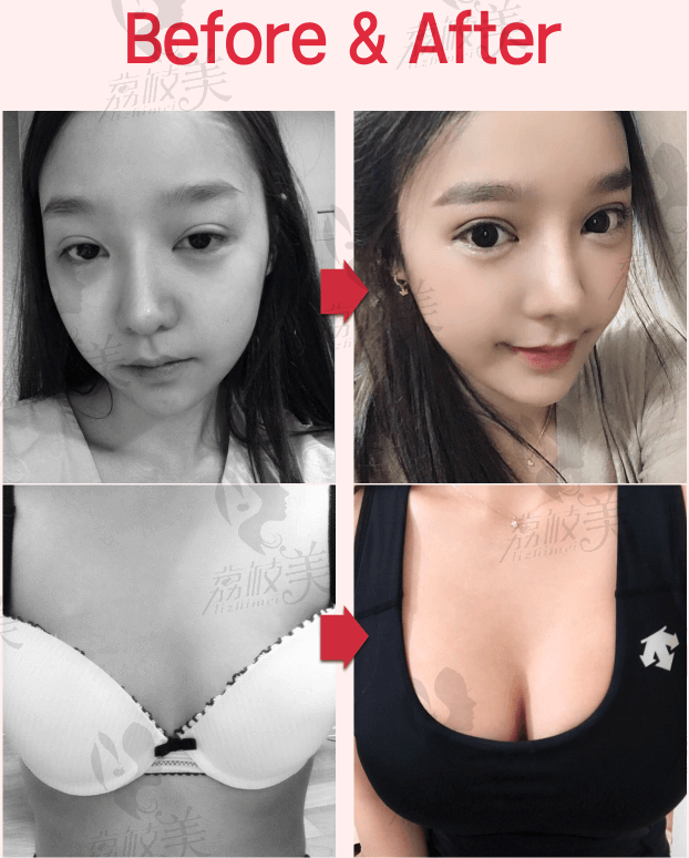 任荣旻眼部修复+隆胸案例.png?x-oss-process=style/lzmei