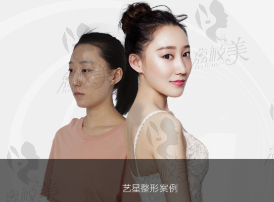 北京艺星25岁小美女面部脂肪填充整形案例