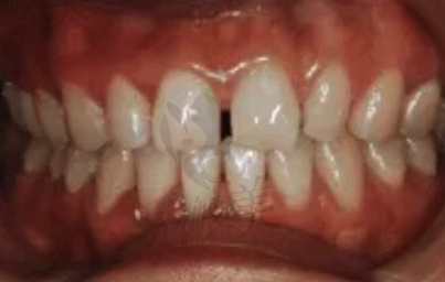 牙缝宽大的原因和解决办法有哪些？矫正和瓷贴面效果好吗