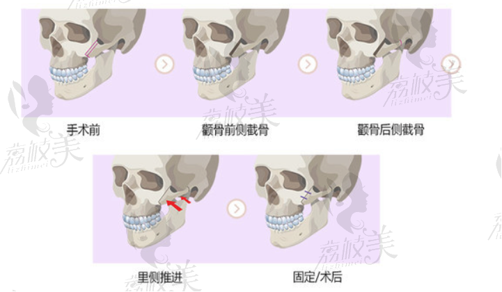 顴骨縮小手術(shù)方法