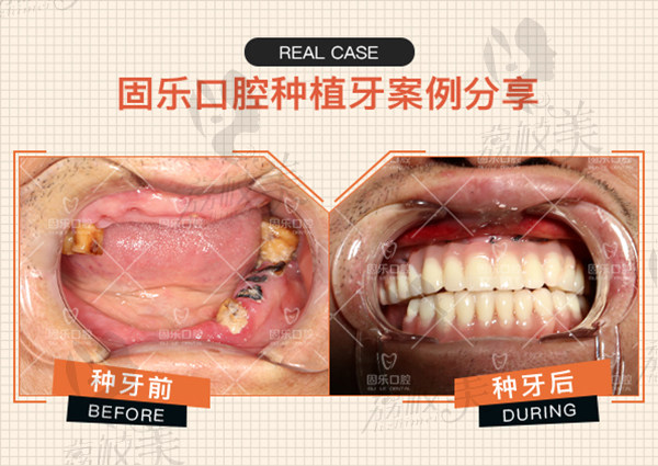 固乐口腔牙齿种植案例