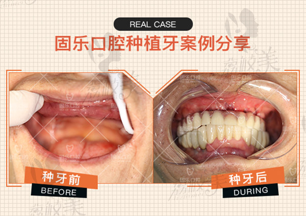 固乐口腔牙齿种植案例
