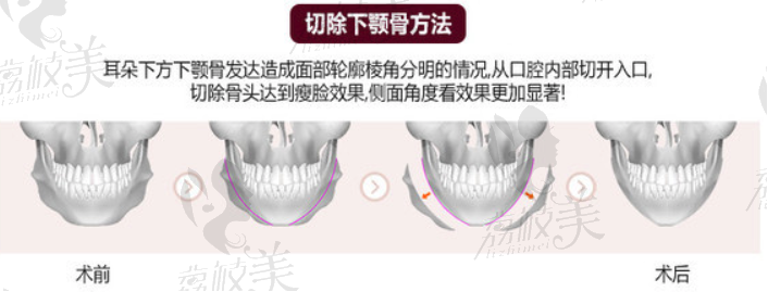 切除下顎骨方法