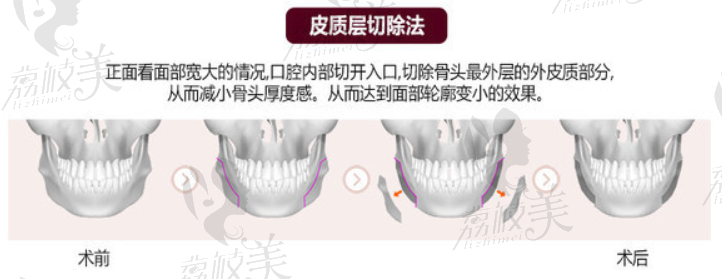 皮質(zhì)層切除法