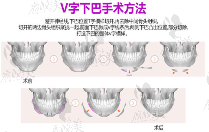 V字下巴手術(shù)方法