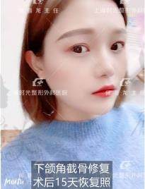 下颌角去骨修复第15天.jpg?x-oss-process=style/lzmei