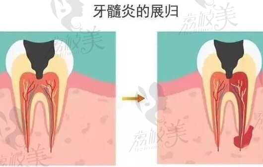 荔枝美：牙髓炎的展归