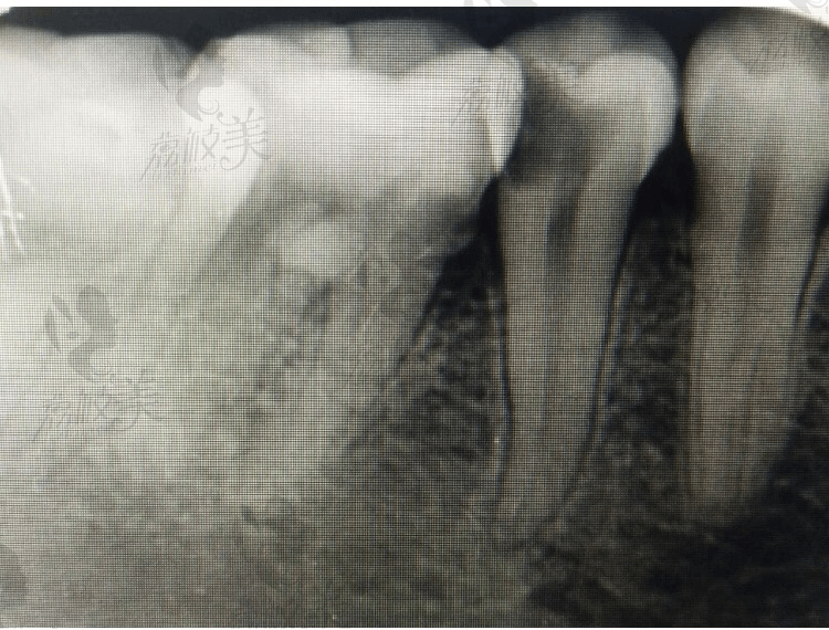 荔枝美：牙髓炎的牙片